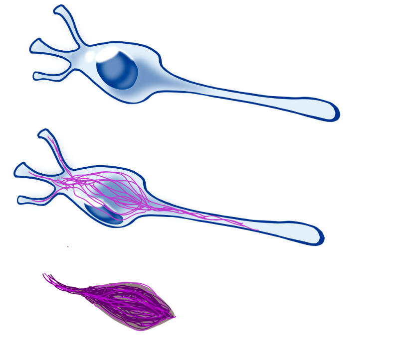 An illustration of tau tangles in a neuron