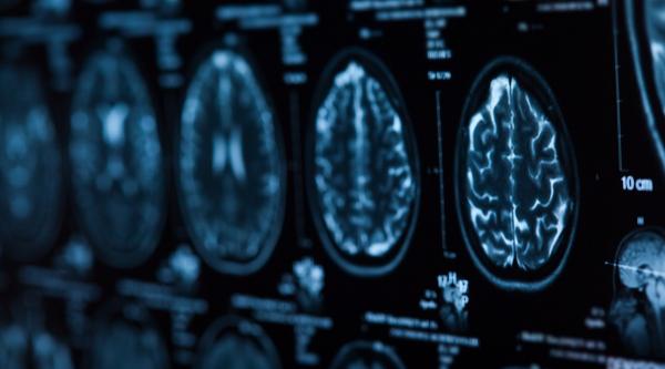 Scans of a brain